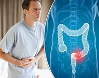 Bowel Cancer Health and Wellbeing